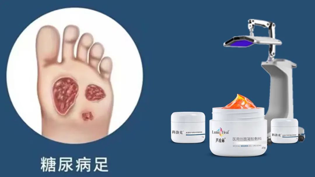 新品蘆玫赫：引領(lǐng)糖尿病足治療進入再生光技術(shù)新時代